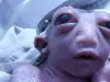 В Индия се роди момиченце с половин глава и огромни очи