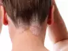 Псориазис мъчи 150 000 нашенци
