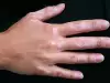 Лечение на витилиго